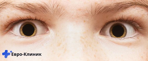 Глаза с расширеными зрачками